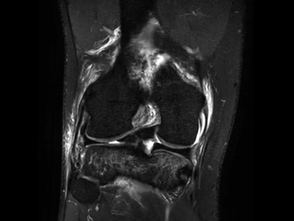 Ingenia Ambition 1.5T X: бесконтактное позиционирование с помощью аудио- и видеоинструкций снижает нервозность пациентов во время МР-исследований